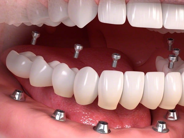 Trồng Implant xong có niềng răng được không ? - Nha Khoa Home