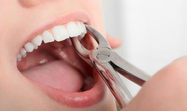 Một số lưu ý để sâu khi nhổ răng khôn có lỗ xuất hiện - Nha Khoa Home