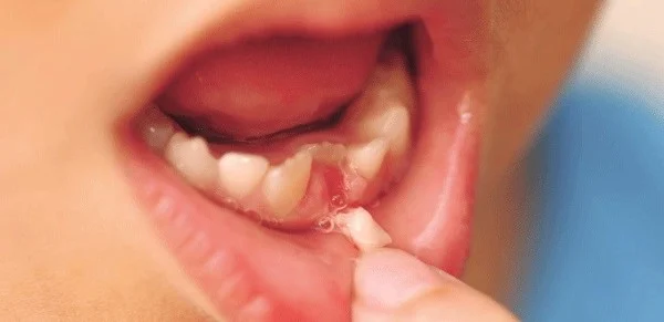 Răng sữa là răng gì? Độ tuổi thay răng sữa cho bé là bao nhiêu? - Nha Khoa Home