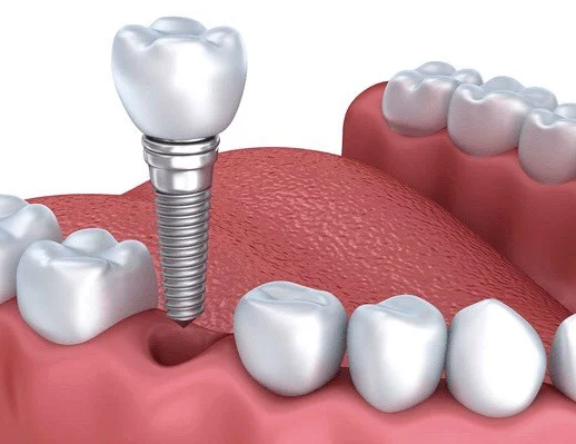 Có nên trồng răng Implant không