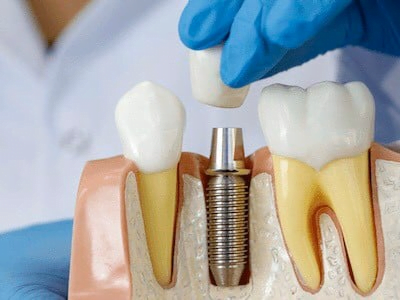 Trồng răng - Cấy ghép Implant là gì