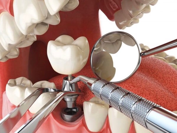 Phải làm gì nếu mão răng Implant bị lỏng - Nha Khoa Home
