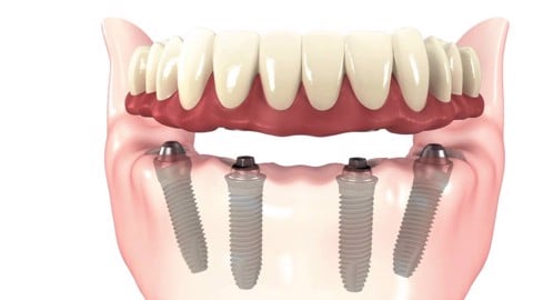 all on 4 dental implants 7bdfa50d2df3466cb9821a1a94d2088a large