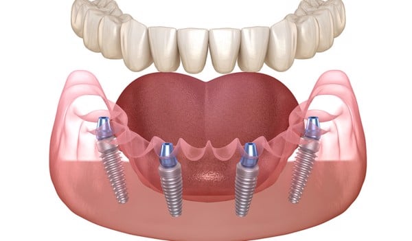 Khác biệt giữa răng Implant và cầu răng sứ - Nha Khoa Home