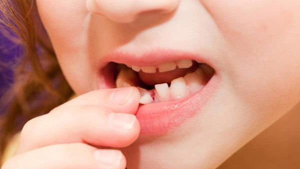 Những cách nhổ răng sữa cho bé tại nhà được áp dụng nhiều nhất - Nha Khoa Home