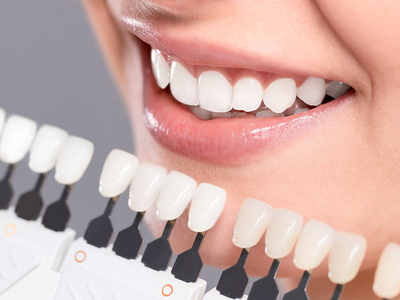 Dán Răng Sứ Veneer Có Tốt Không? - Nha Khoa Home