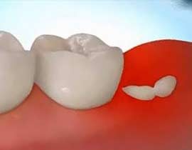 day dental wisdom teeth featured d5d2d0f51efd49aa8fb87e9d255d7775 large