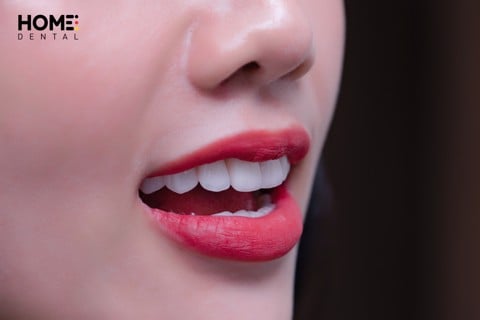 Răng sứ loạI nào tốt nhất và răng sứ có mấy loạI? – Nha Khoa Home