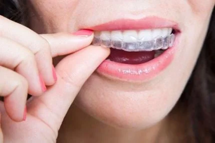 Kem đánh răng nên dùng sau niềng răng - Nha Khoa Home