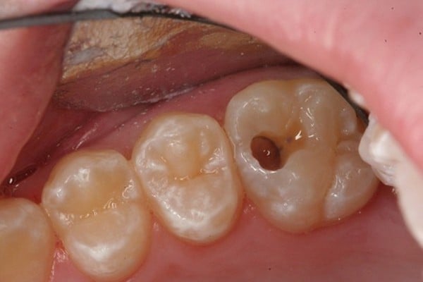 Tìm hiểu về các biến chứng của răng sâu vào tủy - Nha Khoa Home