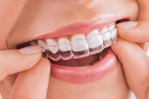 Niềng răng có gây giảm cân không? - Nha Khoa Home