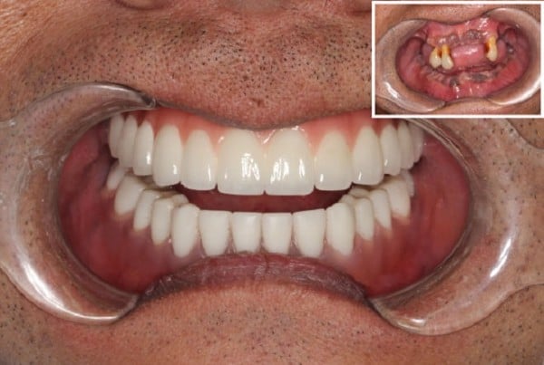 Tại sao răng Implant được ưa chuộng - Nha Khoa Home