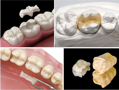 Tìm hiểu về một số loại trám răng thường gặp - Nha Khoa Home