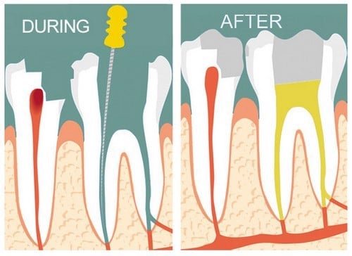 Trước và sau khi trám răng điều trị tủy