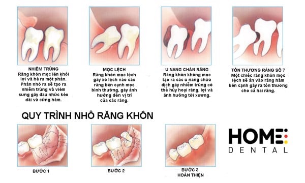Các tình trạng của răng khôn và quy trình xử lý.
