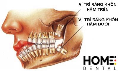 Vị trí các răng khôn ở hai hàm.