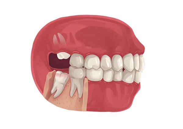 Tất tần tật kinh nghiệm bạn cần biết trước khi nhổ răng khôn - Nha Khoa Home