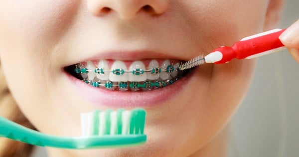 Quá trình chăm sóc răng miệng khi đang sử dụng niềng răng cũng rất quan trọng.