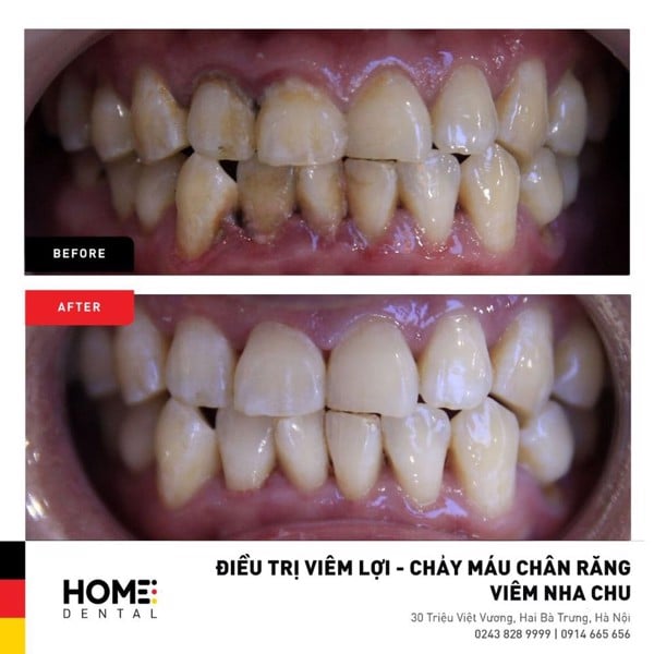 Mất răng ở người lớn: nguyên nhân, xử lý và điều trị - Nha Khoa Home