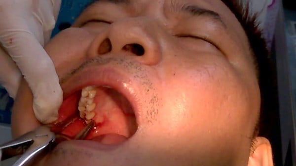Nhổ răng khôn hàm trên bị sâu, nên hay không? – Nha Khoa Home