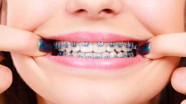 Một số loại hình niềng răng phổ biến & các kiến thức cơ bản cần biết? - Nha Khoa Home