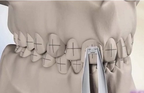 Niềng răng giai đoạn nào đau nhất? Một số lưu ý cho bạn - Nha Khoa Home