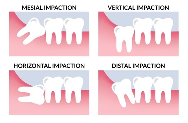Tác dụng của răng khôn với sức khỏe răng miệng - Nha Khoa Home