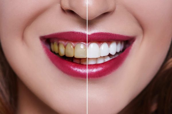 Những điều cơ bản về phương pháp bọc răng sứ thẩm mỹ - Nha Khoa Home