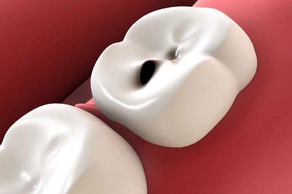 Tác hại của niềng răng: 6 vấn đề sau niềng mà nha sĩ không bao giờ tiết lộ - Nha Khoa Home