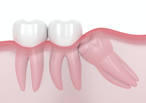 Răng khôn có thể có nhiều vấn đề dẫn tới nhổ bỏ.