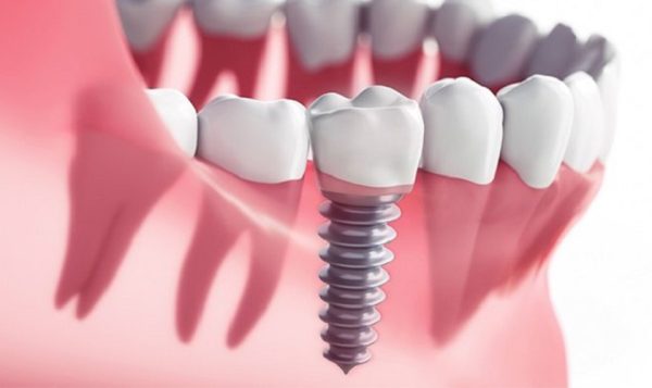 biến chứng trồng răng Implant