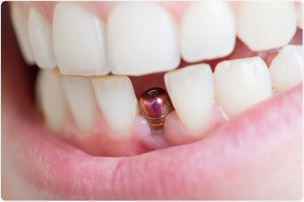 biến chứng trồng răng Implant