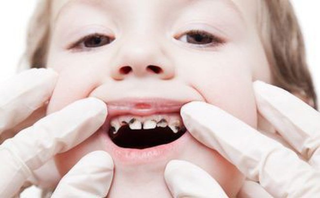 Những thông tin cơ bản mà cha mẹ nên biết khi nhổ răng sâu cho trẻ - Nha Khoa Home