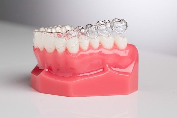 Niềng răng là gì? Tìm hiểu về các loại niềng răng - Nha Khoa Home