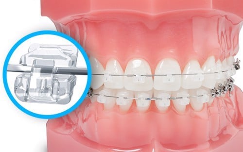 Niềng răng là gì? Tìm hiểu về các loại niềng răng - Nha Khoa Home