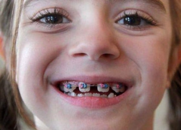 Tại sao nói từ 9 – 12 tuổi là “độ tuổi vàng” để niềng răng? - Nha Khoa Home