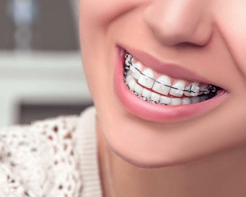 Niềng răng móm - Cách khắc phục móm hiệu quả - Nha Khoa Home