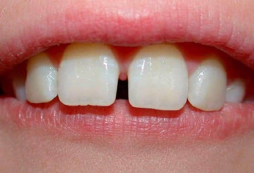 Quy trình trám răng tại nha khoa Home - Nha Khoa Home