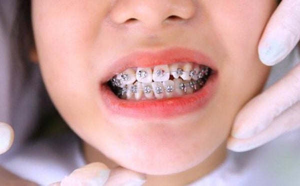 Niềng răng cho trẻ 15 tuổi giá bao nhiêu? 3 loại mắc cài tốt nhất - Nha Khoa Home