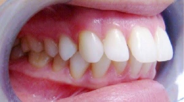 Trong trường hợp răng bị hô, giải pháp là gì?