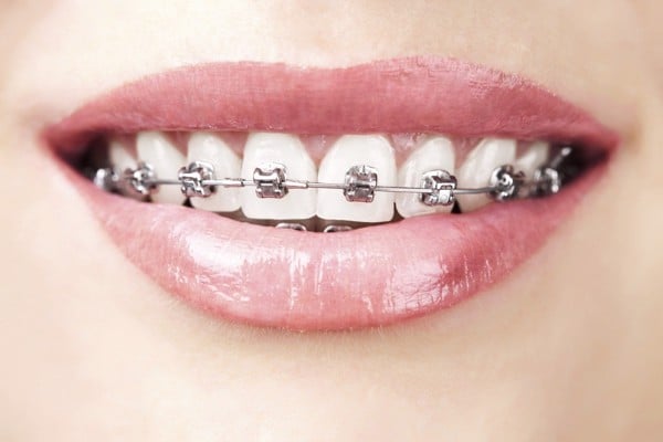 Niềng răng khớp cắn sâu: 6 tác hại, 5 phương pháp niềng răng - Nha Khoa Home