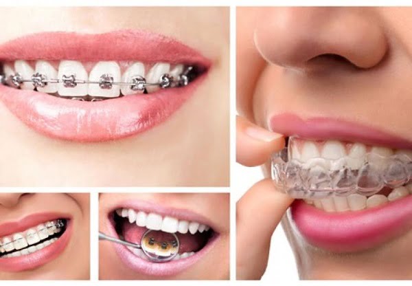 Cách khắc phục tình trạng móm răng sau khi niềng - Nha Khoa Home