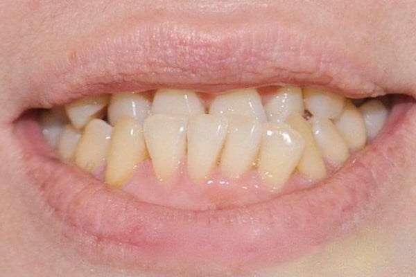 Niềng răng móm - Cách khắc phục móm hiệu quả - Nha Khoa Home