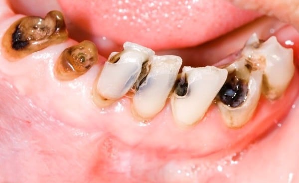 Tìm Hiểu Các Mức Độ Sâu Răng Và Cách Phòng Ngừa - Nha Khoa Home