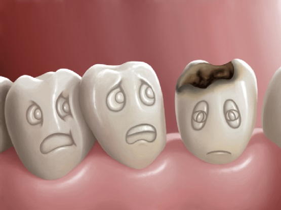Sâu răng mới chớm tự khỏi được không? và cách giải quyết thế nào là tốt nhất - Nha Khoa Home