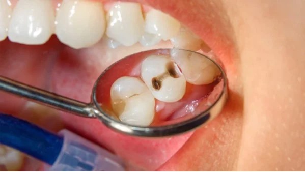 Tẩy trắng răng - nên và không nên - Nha Khoa Home