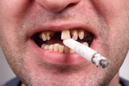Các chất hóa học và khói thuốc lá là tác nhân gây ố vàng, chuyển màu răng.