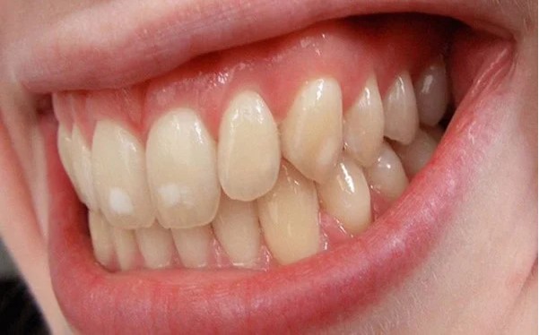 Tẩy trắng răng - nên và không nên - Nha Khoa Home