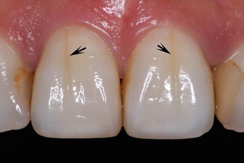 Tìm hiểu nguyên nhân khiến răng sứ bị nứt - Nha Khoa Home