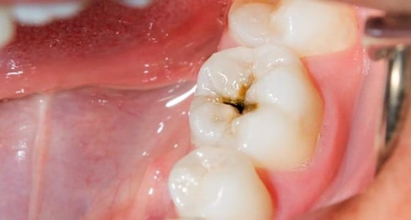 Sâu răng rất phổ biến ở mọi lứa tuổi.